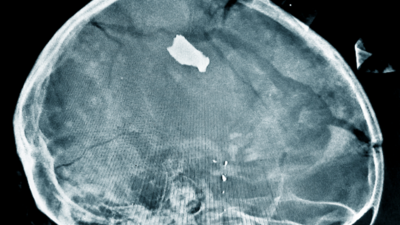 X-ray sudan 2