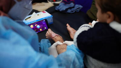Burn Care in Gaza
