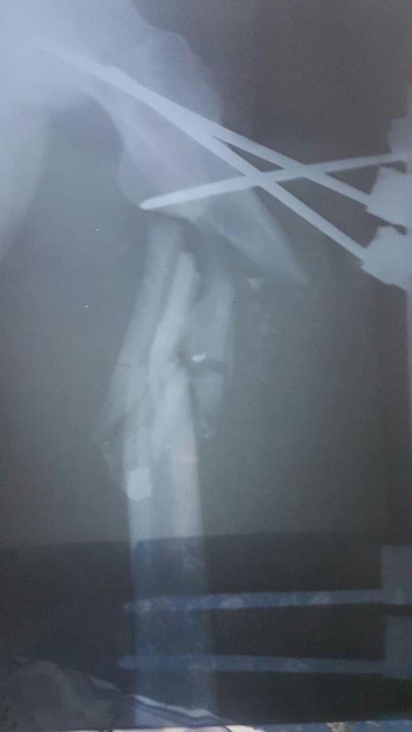 Abu fracture