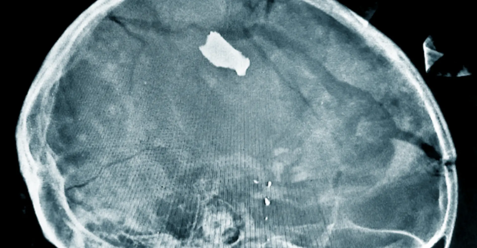 X-ray sudan 2