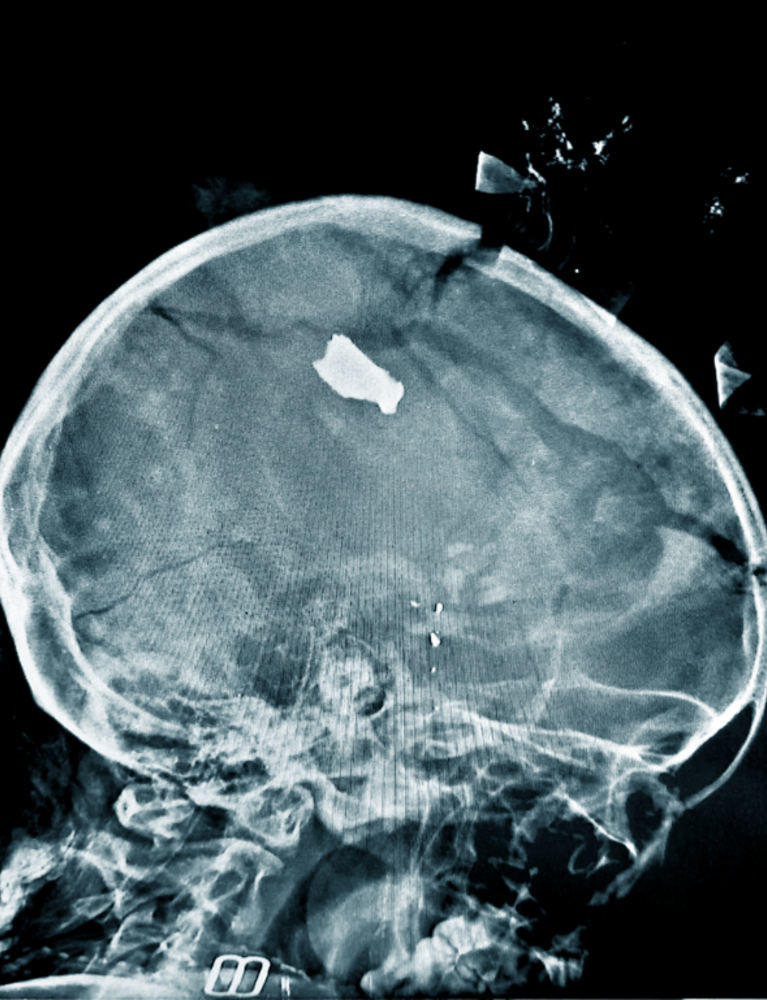 X-ray sudan 2